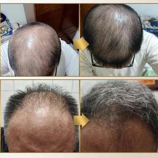 夏天只洗頭不養頭皮？你可能正默默 禿頭中